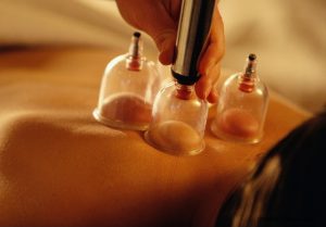 cupping