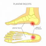 Plantar Fasciitis