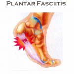 Plantar Fasciitis2